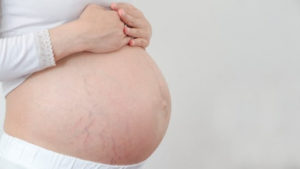 Prevenir Estrias Durante El Embarazo