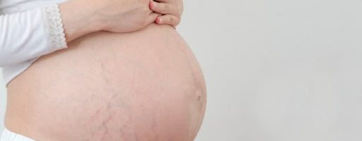 Prevenir Estrias Durante El Embarazo